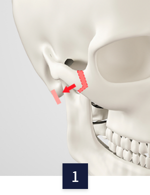 cheek_method1-2.png cheek_method1-2.png