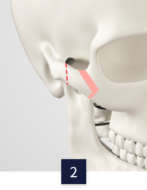 cheek_method2.png cheek_method2.png