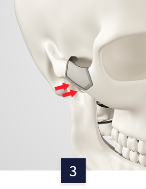 cheek_method3.png cheek_method3.png