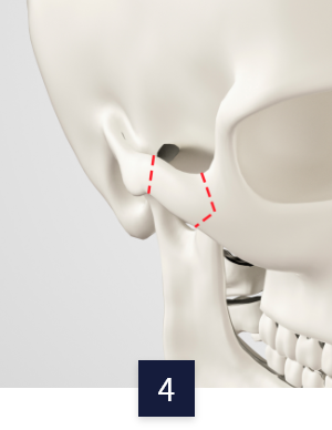 cheek_method4.png cheek_method4.png