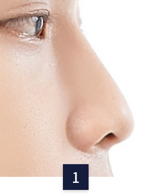 수술 방법