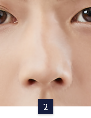 수술 방법