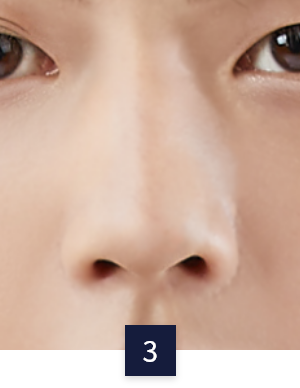 수술 방법