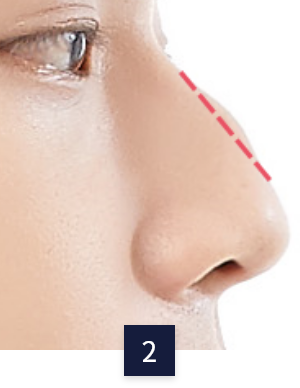 수술 방법