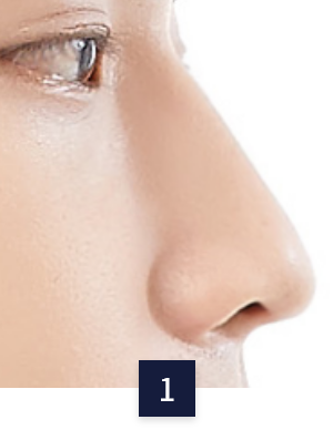 수술 방법