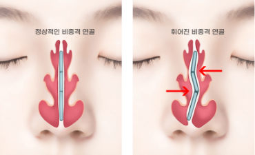 nose_improvement1.png nose_improvement1.png