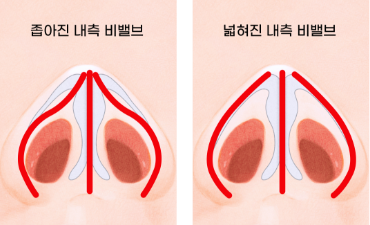 nose_improvement3.png nose_improvement3.png