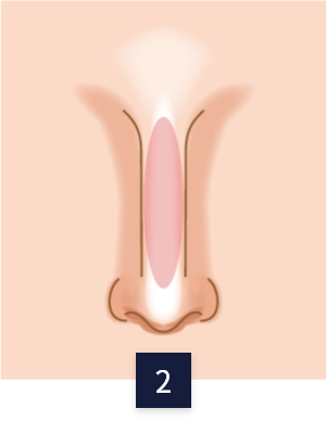 수술 방법
