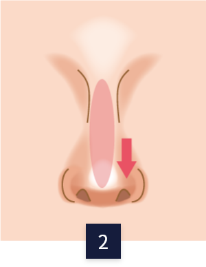 수술 방법