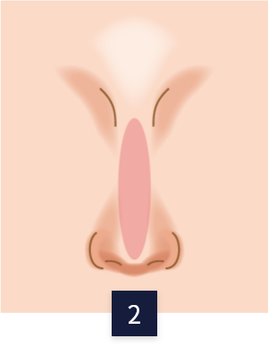 수술 방법