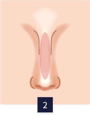 수술 방법