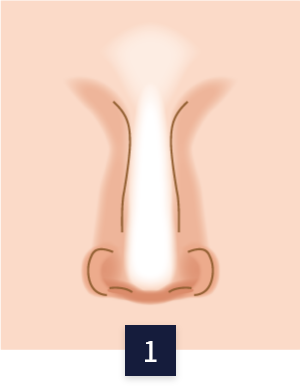 수술 방법