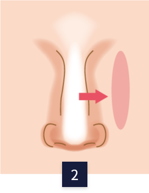수술 방법