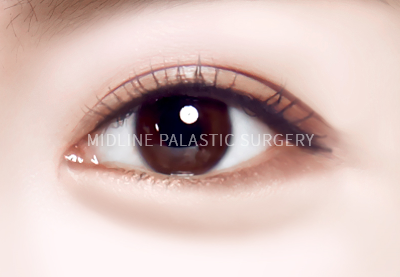 under-eye-title2.png under-eye-title2.png