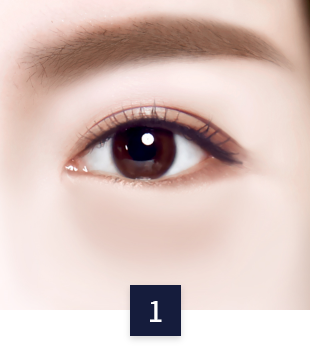 under-eye_case1.png under-eye_case1.png