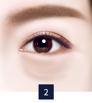 under-eye_case2.png under-eye_case2.png