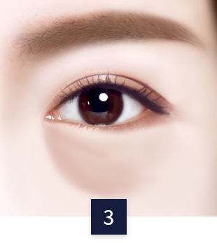 under-eye_case3.png under-eye_case3.png