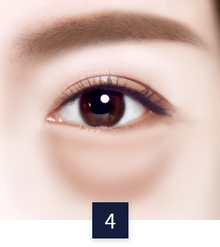 under-eye_case4.png under-eye_case4.png