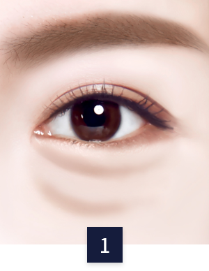 수술 방법