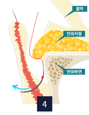 수술 방법