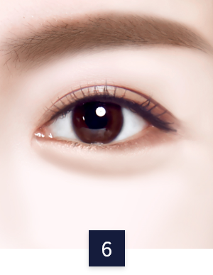수술 방법