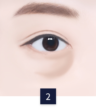 under-eye_necessary2.png under-eye_necessary2.png