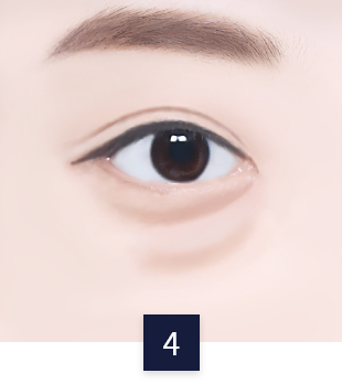 under-eye_necessary4.png under-eye_necessary4.png