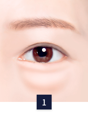 수술 방법