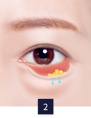 수술 방법