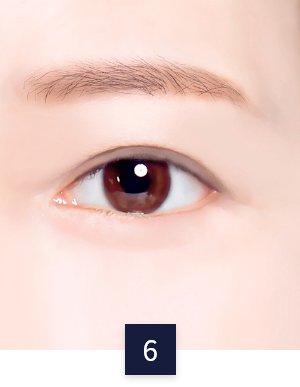 수술 방법