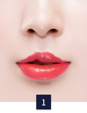 cleft-lip_method02-1.png cleft-lip_method02-1.png