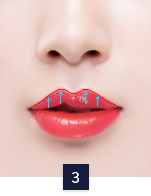 cleft-lip_method02-3.png cleft-lip_method02-3.png