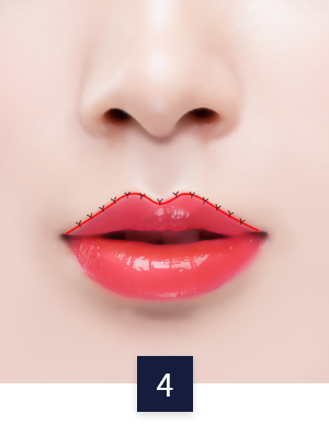 cleft-lip_method02-4.png cleft-lip_method02-4.png