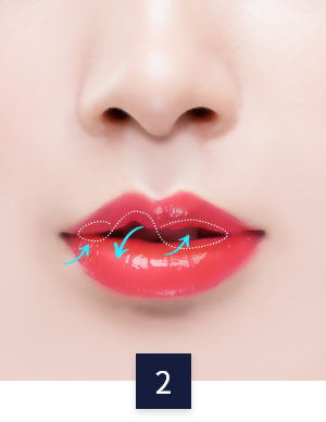 수술 방법