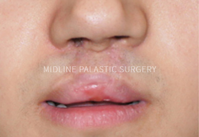 cleft-lip_title1.png cleft-lip_title1.png