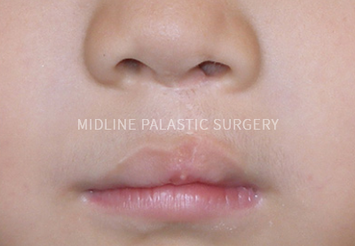 cleft-lip_title2.png cleft-lip_title2.png