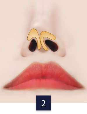 안면목거상 수술 방법
