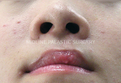 cleft-nose_title1.png cleft-nose_title1.png
