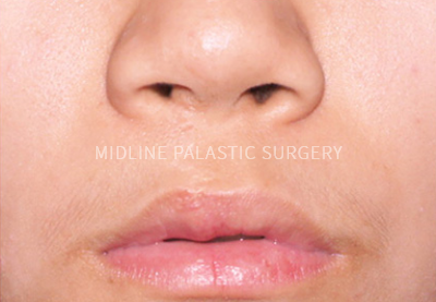 cleft-nose_title2.png cleft-nose_title2.png
