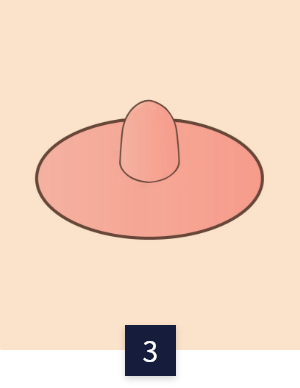 수술 방법