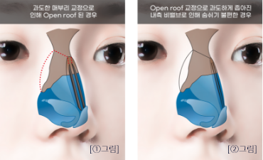 nose_improvement2-1.png nose_improvement2-1.png