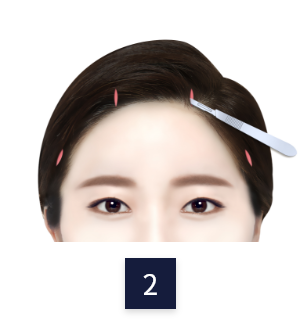 수술 방법