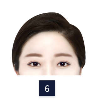 수술 방법