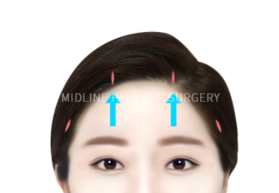 lifting-forehead_title1.png lifting-forehead_title1.png