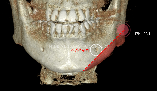 facial-square-jaw1.png facial-square-jaw1.png
