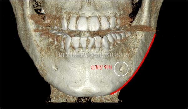 facial-square-jaw2.png facial-square-jaw2.png