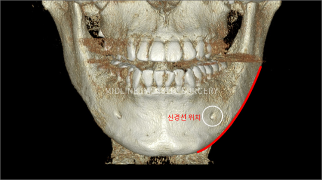 facial-square-jaw4.png facial-square-jaw4.png