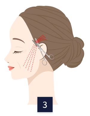 lifting-thread_method3.png lifting-thread_method3.png