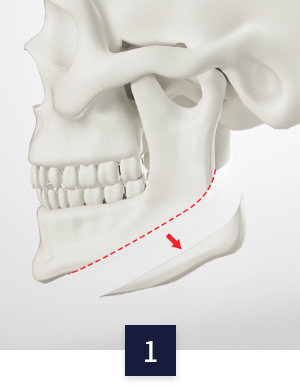 square-jaw_method1.png square-jaw_method1.png