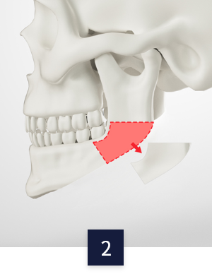 square-jaw_method2.png square-jaw_method2.png